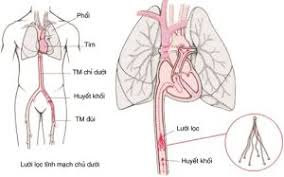 Huyết khối tĩnh mạch cửa gây ra những vấn đề gì cho cơ thể?
