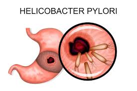 Nhiễm khuẩn HP (Helicobacter Pylori) | BvNTP