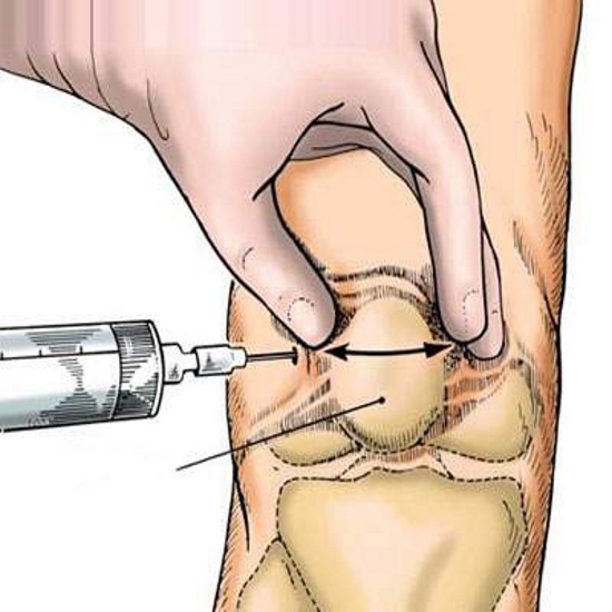 Quy trình chăm sóc và lưu ý sau khi tiêm khớp gối là gì để đảm bảo kết quả tốt nhất?