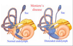 Bệnh Meniere có liên quan đến tuổi tác hay không? 
