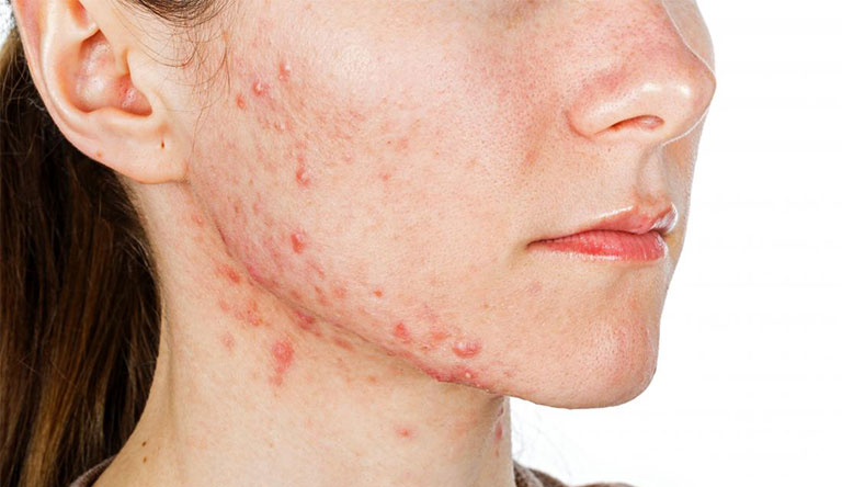 Làm thế nào môi trường ô nhiễm và tác động của môi trường có thể gây ra mụn viêm trên da?