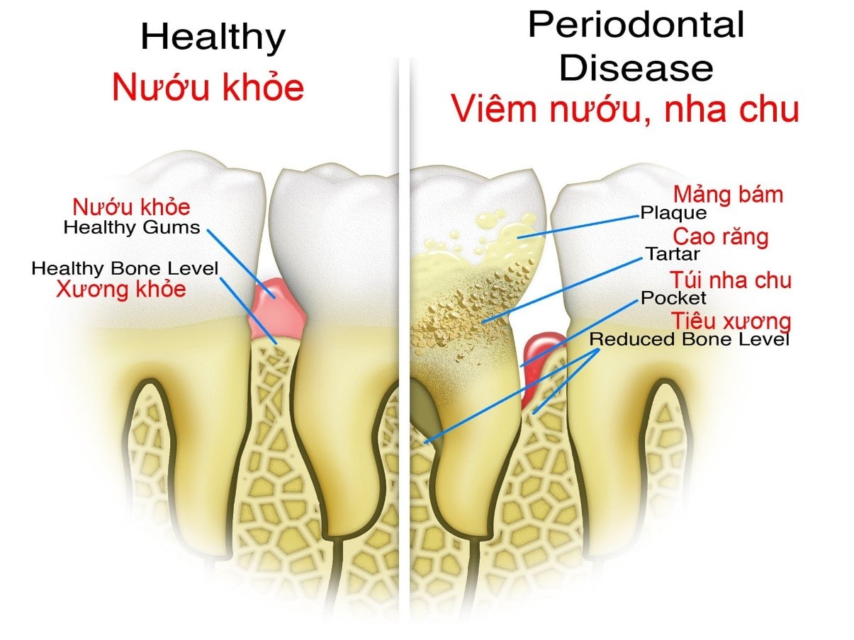 Nguyên nhân nào gây nhiễm trùng chân răng?
