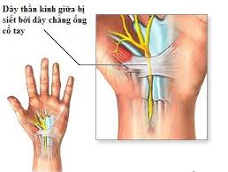 Liệu có tác dụng phụ nào sau khi tiêm khớp cổ tay không?
