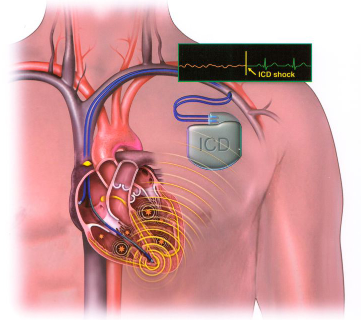 Vai trò của máy tạo nhịp tim | BvNTP