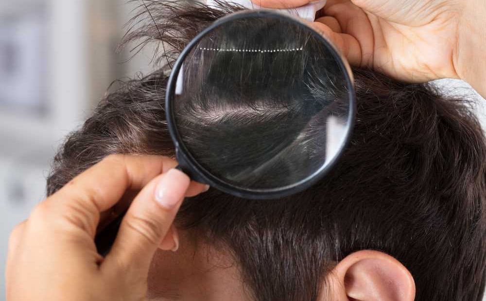 Nguyên nhân và cách điều trị tóc thưa mỏng  BvNTP