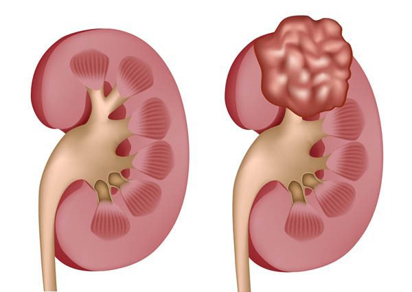 Các yếu tố nguy cơ gây ra u thận RCC là gì?
