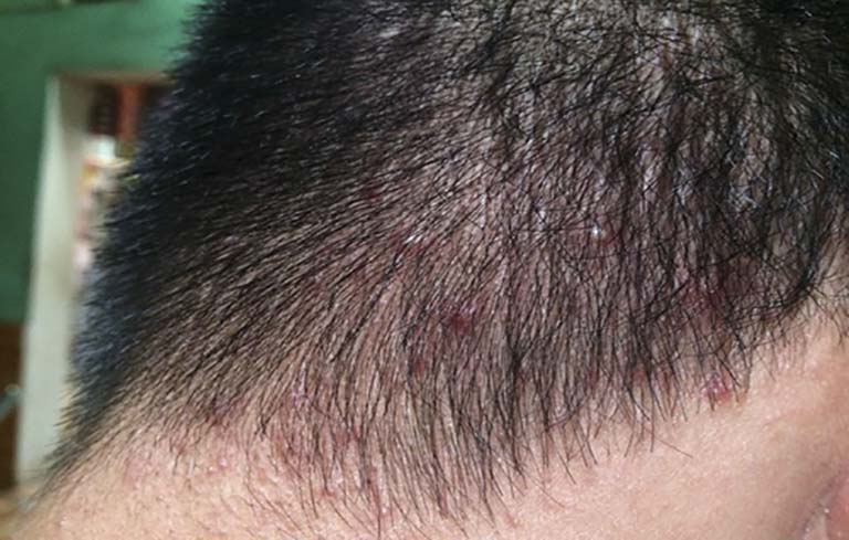 Những điều cần biết về viêm nang lông ở đầu và cách trị liệu