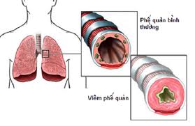 Những người có nguy cơ cao mắc phải đợt cấp viêm phế quản mạn là ai?
