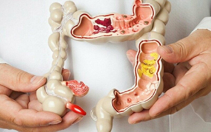 Triệu chứng và biến chứng của bệnh Crohn