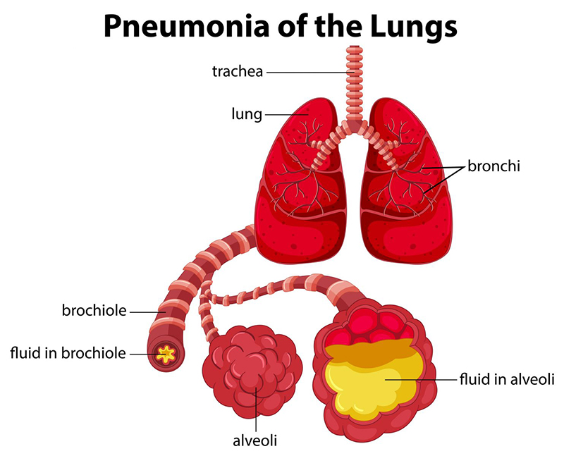 Phân loại viêm phổi 