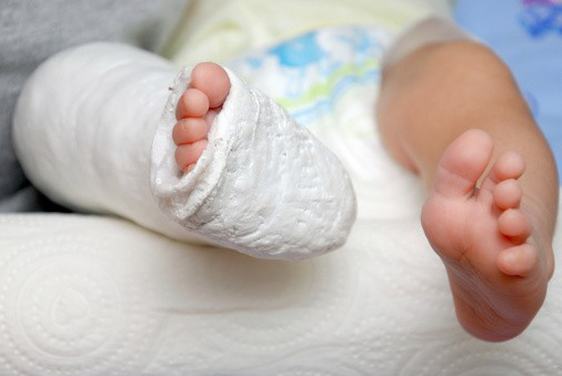 điều trị tật nhón chân ở trẻ