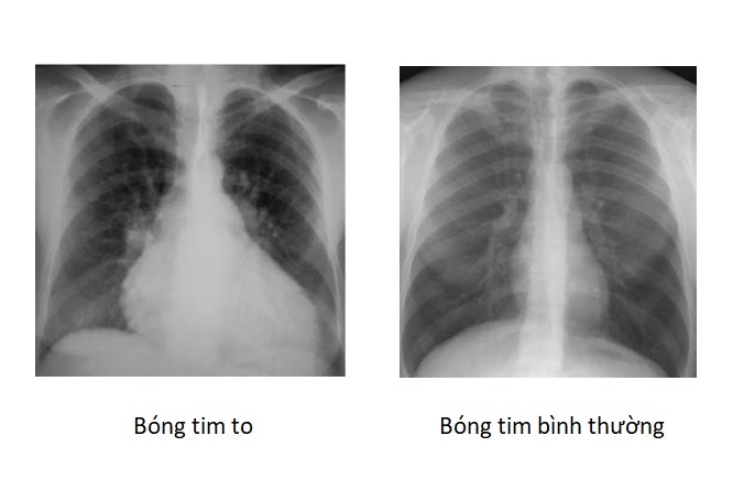 Bóng tim to trên X Quang tim phổi | BvNTP