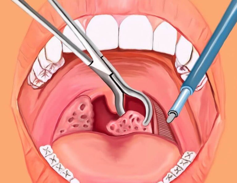 Cắt amidan bằng dao điện có phải là phương pháp tiên tiến nhất hiện nay không? Nếu không, thì cái nào là phương pháp tiên tiến nhất?
