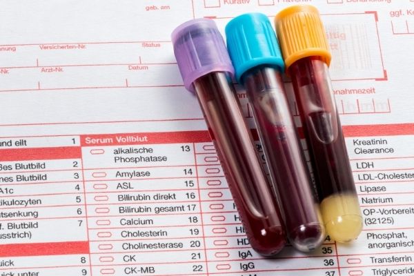 Có thể giảm giá trị GGT trong xét nghiệm máu bằng cách nào?
