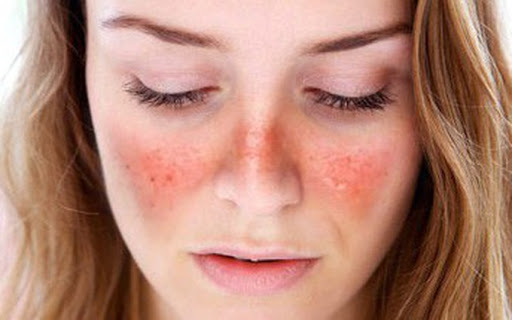 Thuốc Sulfamid làm tăng nguy cơ bị lupus ban đỏ khi tiếp xúc với ánh nắng mặt trời, bạn có thể giải thích cơ chế này không?
