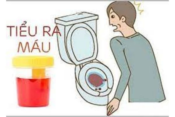 Các triệu chứng khác đi kèm với tình trạng tiểu ra máu ở nam giới là gì?
