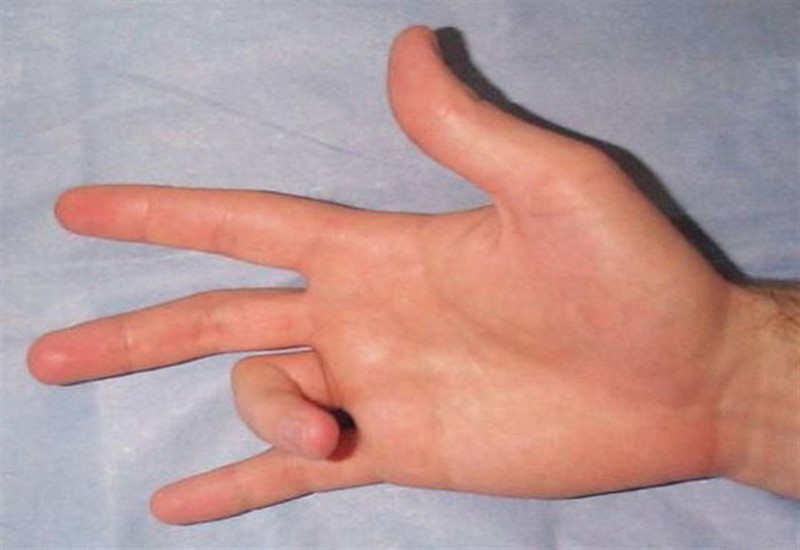 cách điều trị viêm bao gân ngón tay