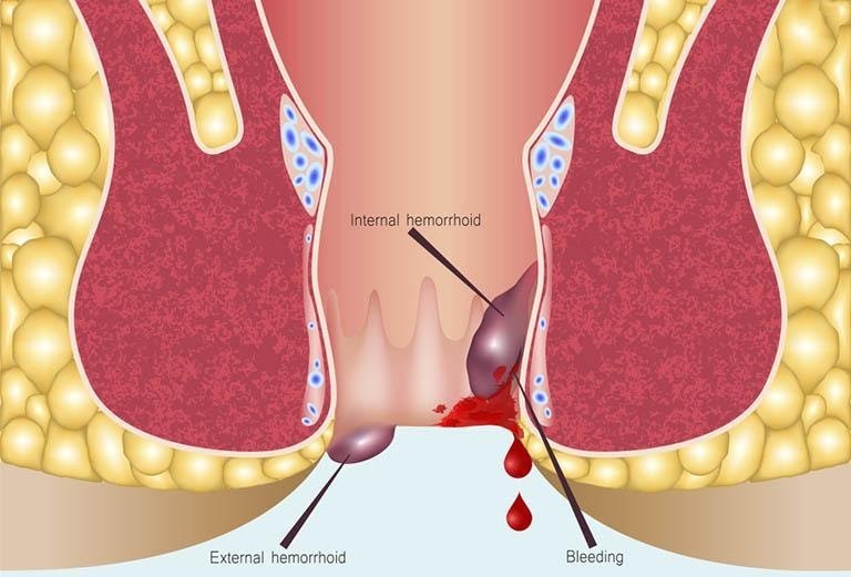 Các triệu chứng lòi dom hậu môn bình thường cần biết