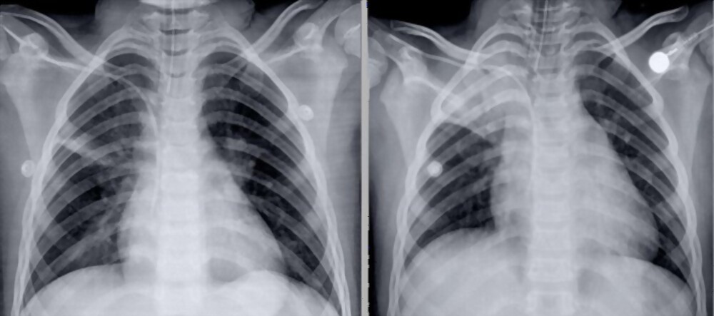 Làm thế nào để nhận biết triệu chứng xẹp phổi?
