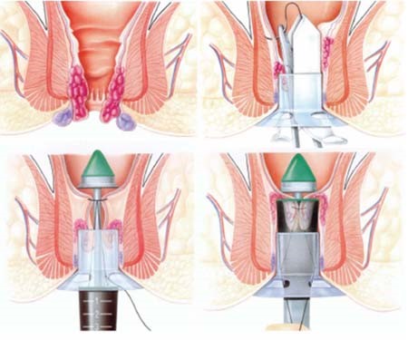 can thiệp y tế khi bị bệnh trĩ