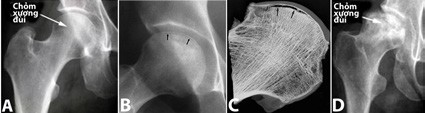Triệu chứng của bệnh hoại tử vô mạch chỏm xương đùi 