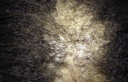 ✅ 10 Lý do ngứa da đầu và cách giảm nhẹ