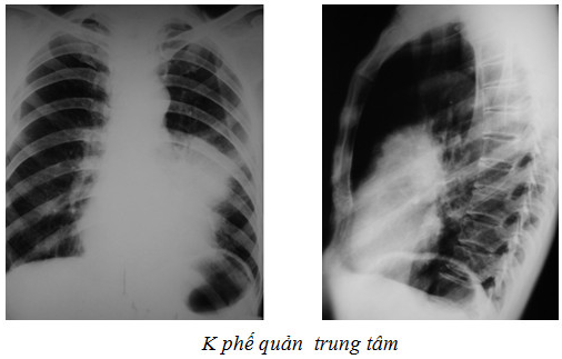 X quang U phổi là một công nghệ y tế tiên tiến giúp chẩn đoán các bệnh về đường hô hấp. Hãy xem hình ảnh liên quan để hình dung rõ hơn về cách thức và độ chính xác của phương pháp này.