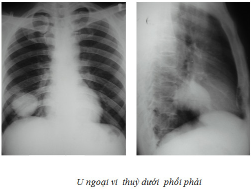 X quang U phổi: X quang U phổi là phương pháp chẩn đoán tiên tiến giúp phát hiện nhanh chóng các bệnh lý phổi. Hãy cùng xem ngay hình ảnh liên quan để tìm hiểu thêm về các thông tin cần thiết cho sức khỏe của bạn.