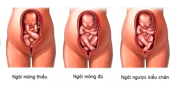 ngôi thai bất thường