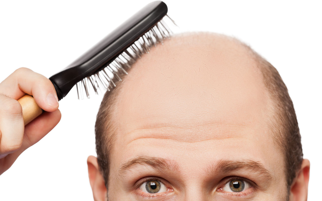 rụng tóc ở nam giới do hormone