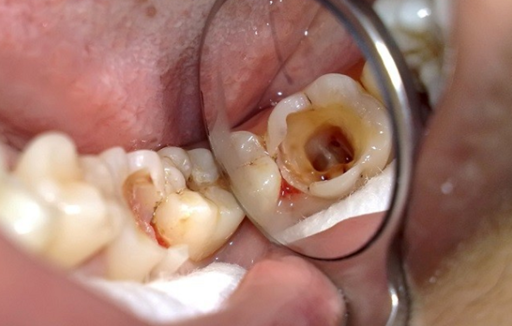 nhiễm trùng chân răng