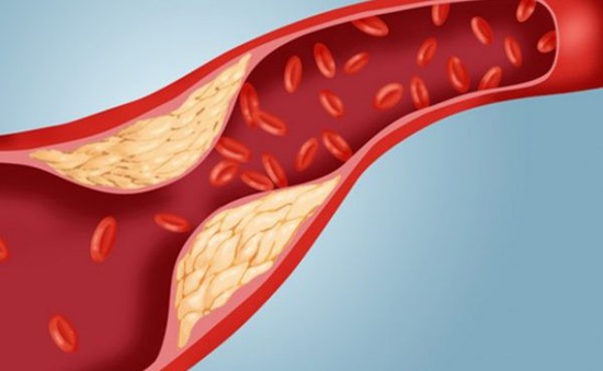 cholesterol và bệnh tim mạch