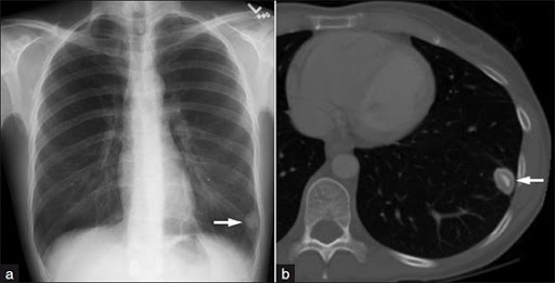 Chụp CT phổi định kì tầm soát ung thư phổi