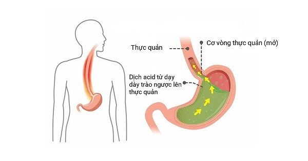 Ợ chua, nóng rát cổ họng có phải là triệu chứng trào ngược dạ dày | BvNTP