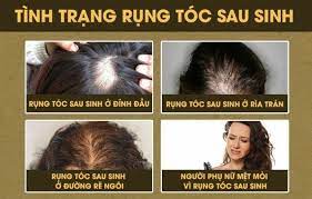 Rụng tóc nhiều ở nữ tuổi 17 có sao không và lời khuyên hữu ích từ chuyên gia