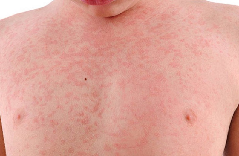 Triệu chứng nhận biết bệnh sốt phát ban ở người lớn