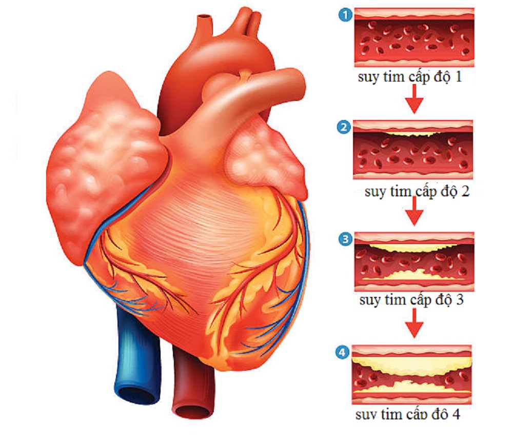 Suy tim cấp gây triệu chứng gì