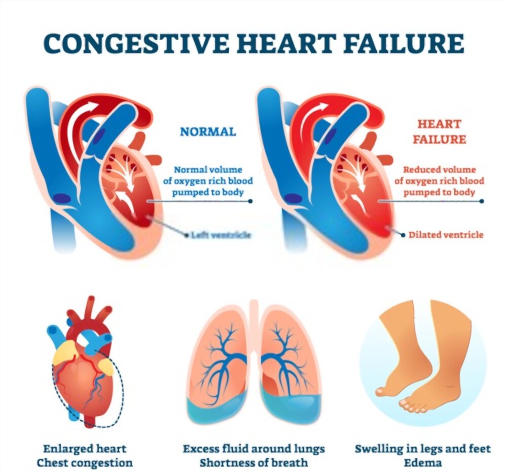 Nguyên nhân của suy tim sung huyết