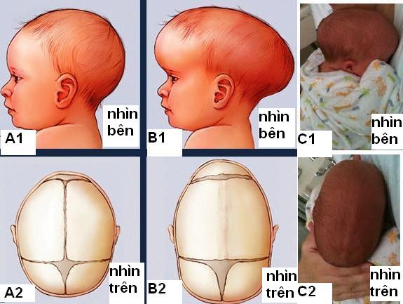 Dị tật dính khớp sọ sớm và các dị tật về hộp sọ ở trẻ em | BvNTP