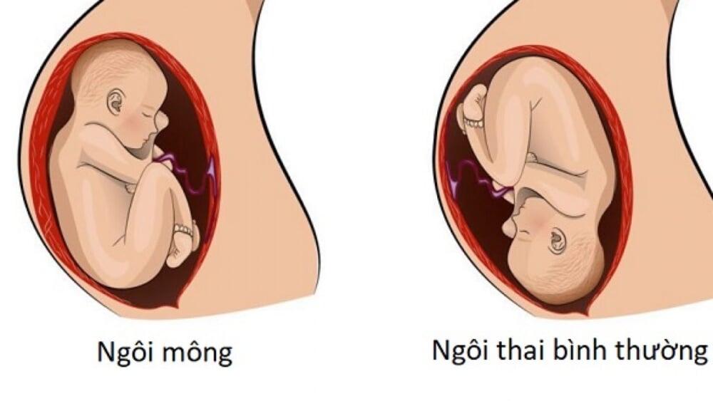 Thế nào là thai nhi ngôi mông?