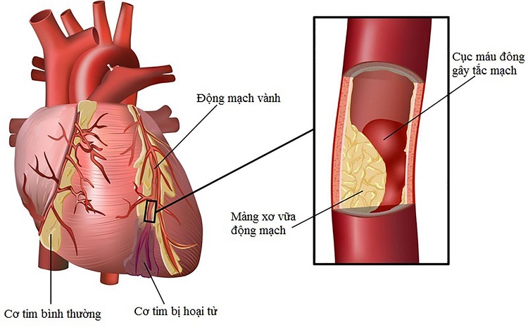 Triệu chứng của bệnh thiếu máu cơ tim