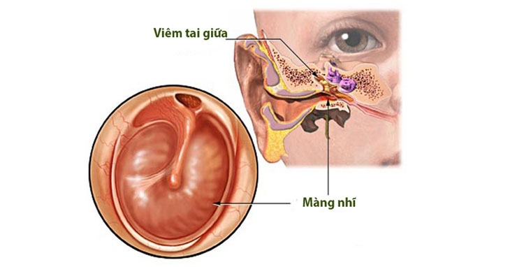 Nguyên nhân gây viêm tai giữa là gì?