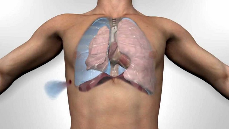 Tràn khí màng phổi là bệnh như thế nào 