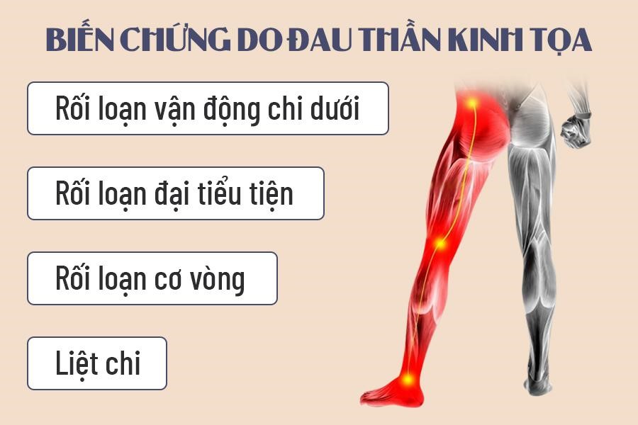 Đau dây thần kinh tọa | BvNTP