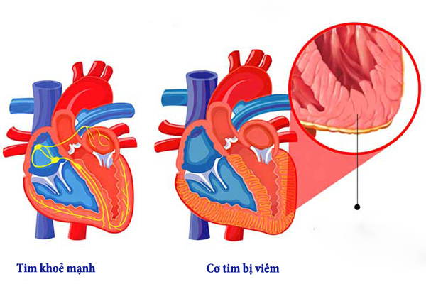 Một số triệu chứng viêm cơ tim không thể bỏ qua