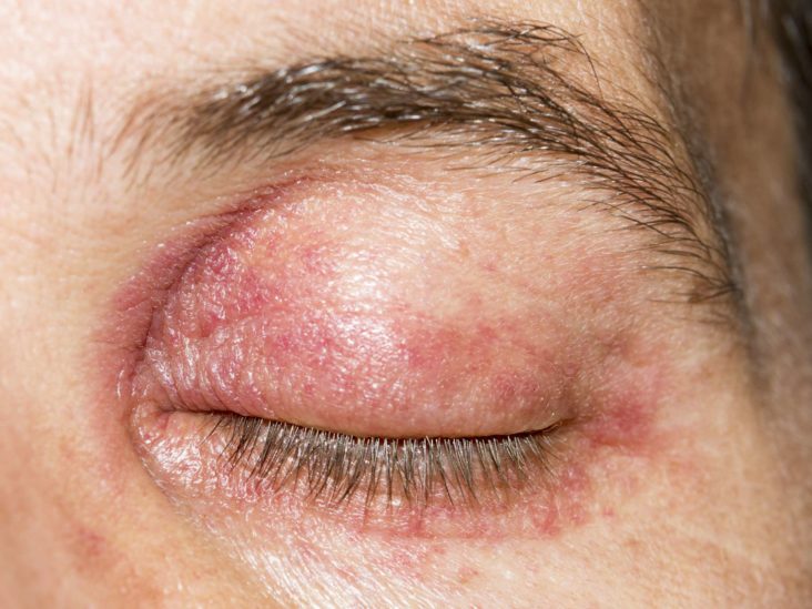 Các yếu tố kích thích gây viêm da quanh mắt