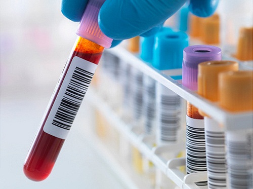 Tìm hiểu về các loại xét nghiệm sinh hóa máu